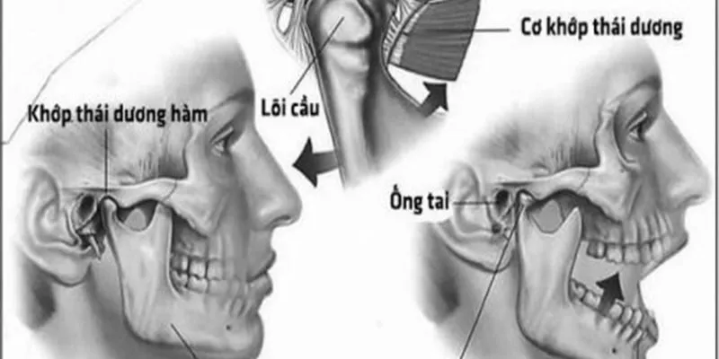 Đau do loạn năng khớp thái dương hàm