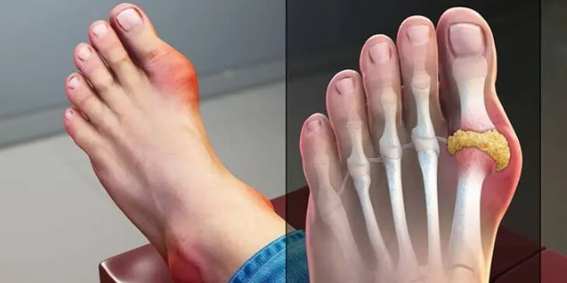 Đau khớp ngón chân