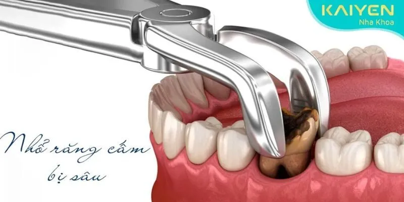 Điều trị sau can thiệp nha khoa