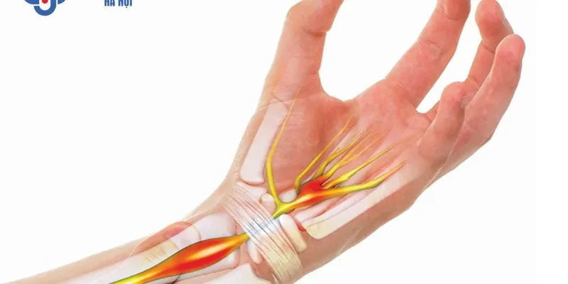 Hội chứng ống cổ tay
