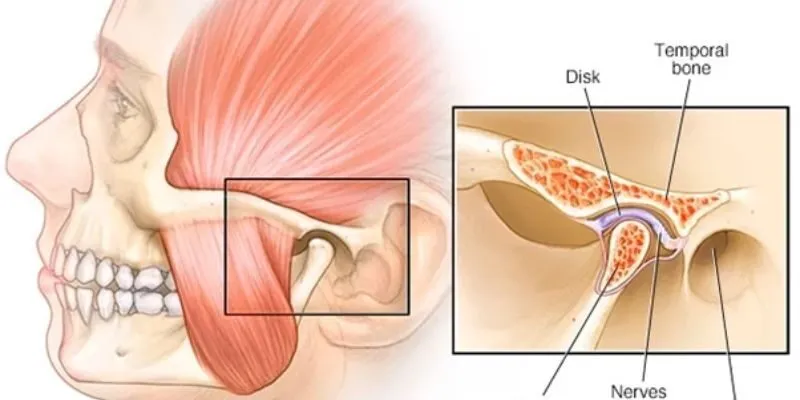 Đau do loạn năng khớp thái dương hàm