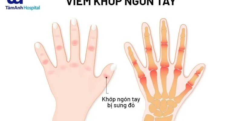 Đau khớp ngón tay