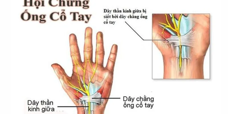 Hội chứng ống cổ tay