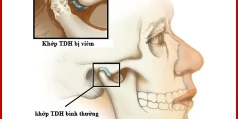 Đau do loạn năng khớp thái dương hàm