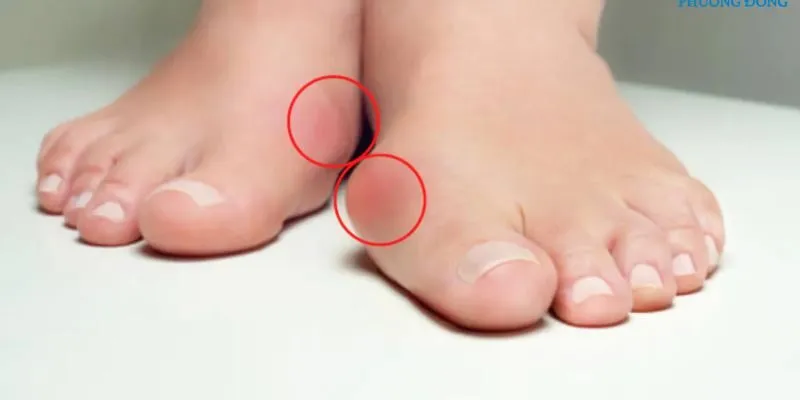 Đau khớp ngón chân