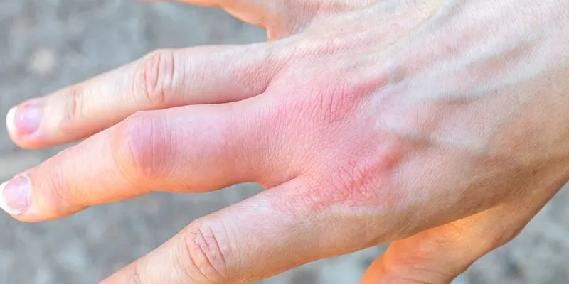 Đau khớp ngón tay