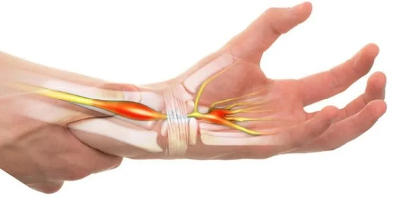 Hội chứng ống cổ tay